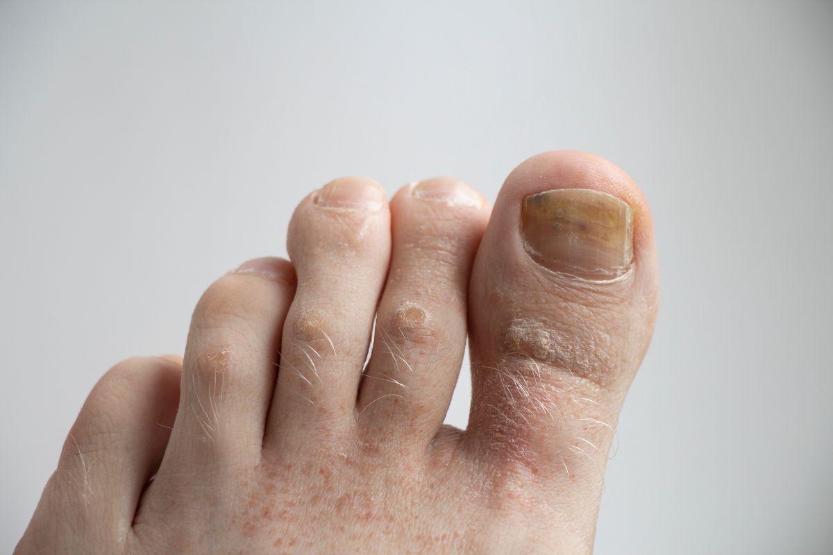 Como acabar com fungos nas unhas rapidamente